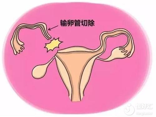 輸卵管切除還能懷孕嗎？醫(yī)生：試管嬰兒可一試