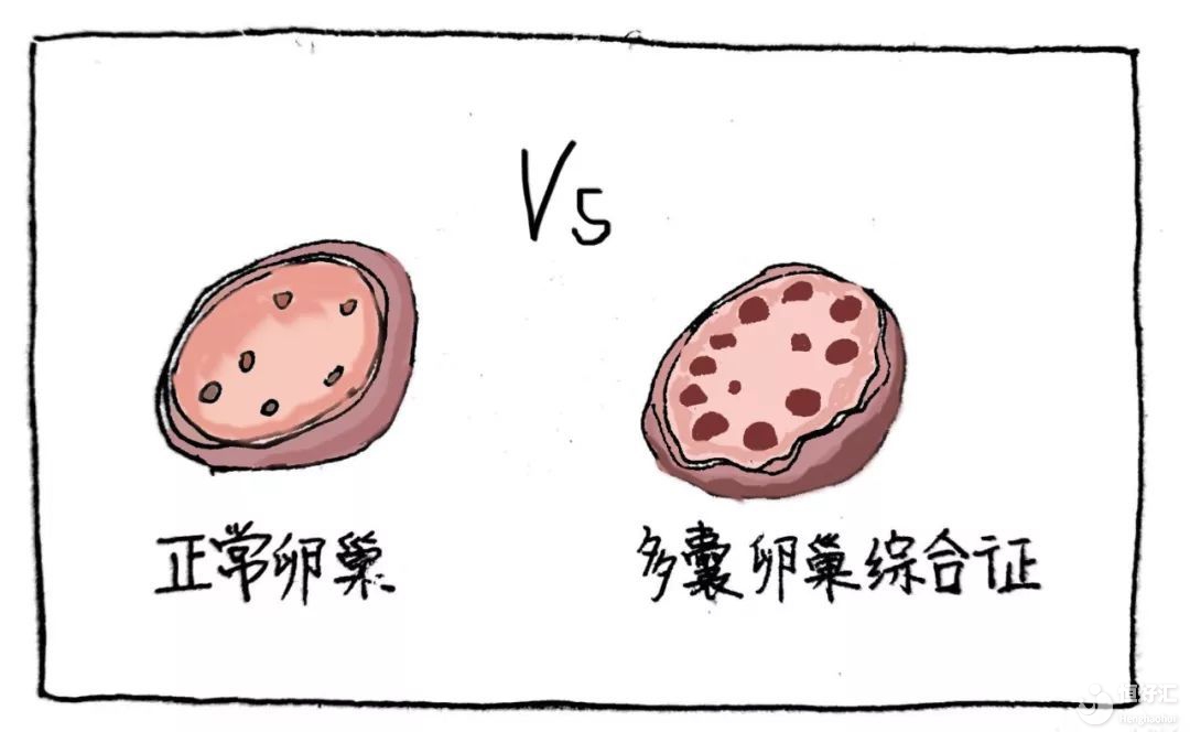注意！多囊卵巢綜合征可能會引起并發癥，你還敢忽視嗎？