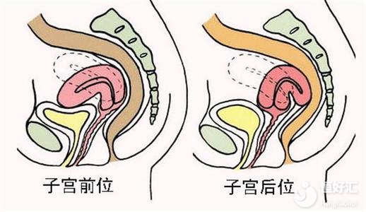 子宮后位或許會增加不孕幾率，這幾點問題請注意