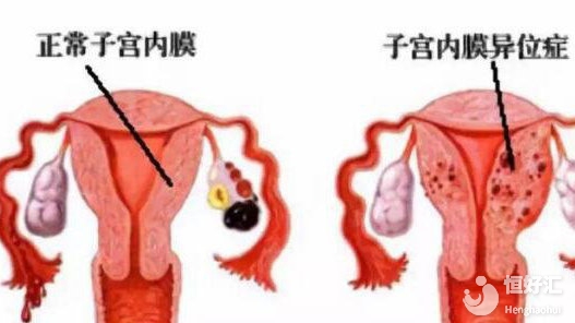 你知道子宮內膜異位癥都有哪些表現嗎？快看這里