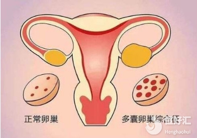 多囊應該如何備孕試管嬰兒？看這里就知道了