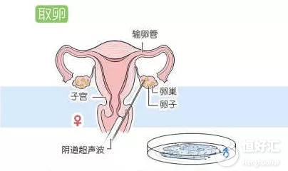 取卵數量決定試管成功率？這5點才是關鍵！