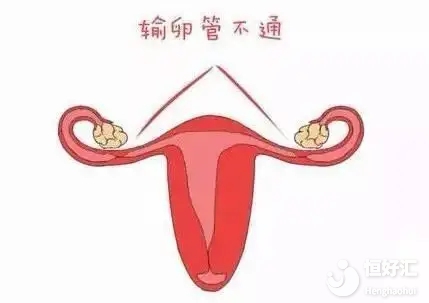 <strong>為什么十個不孕女性有七個是輸卵管原因？</strong>