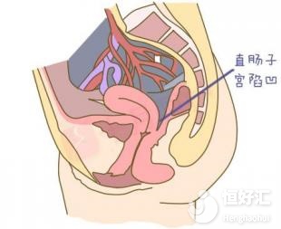 <strong>檢查發現有盆腔積液，需要治療嗎？</strong>