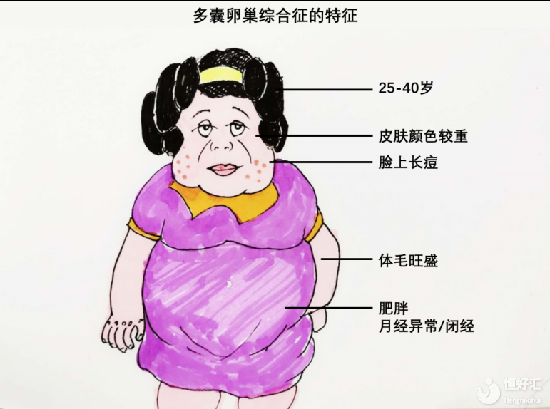 多囊主要看b超還是激素？卵泡大于12個就一定是多囊嗎？