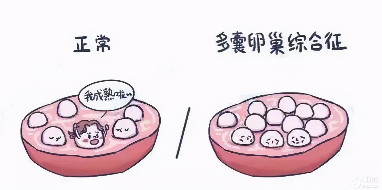 多囊卵巢拖久了會怎樣？不生育就不用治?