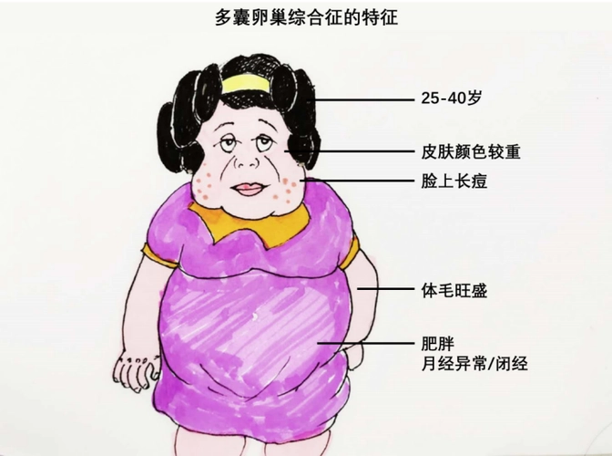 多囊卵巢綜合征科普知識(shí):診斷標(biāo)準(zhǔn)~表現(xiàn)癥狀~