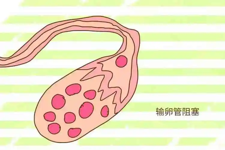 輸卵管為何會(huì)阻塞？有什么預(yù)防措施？