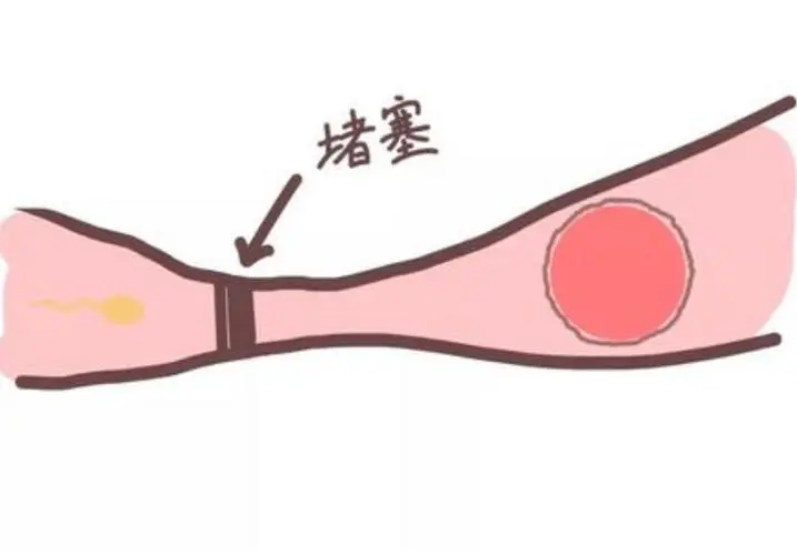 為什么會(huì)懷不上？可能是輸卵管堵塞，看看有沒這些癥狀