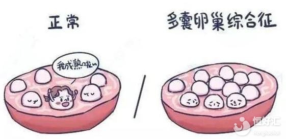 什么是多囊卵巢綜合征？其主要的臨床表現是什么？