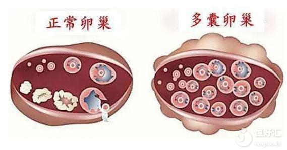 多囊卵巢不運(yùn)動(dòng)不治療，會(huì)導(dǎo)致不孕？
